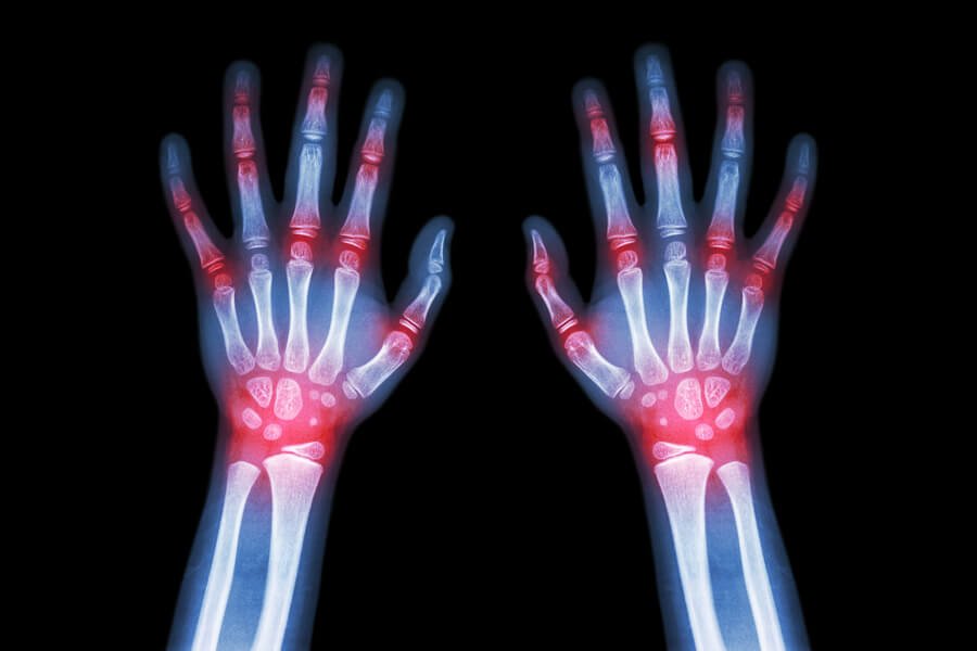What should I do if I’ve suffered Repetitive Strain Injury at work?