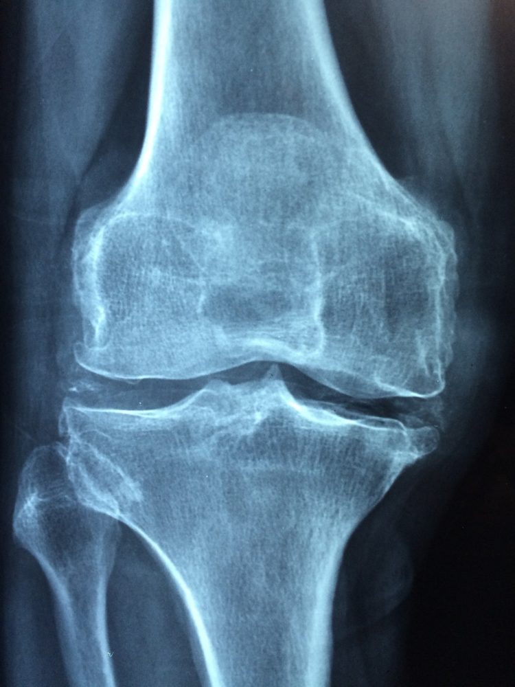 The Most Commonly Broken Bones