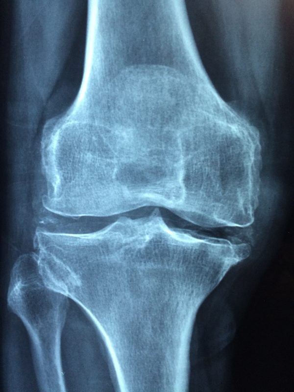 Companies Fined After Employee Suffers Leg Injuries at Work